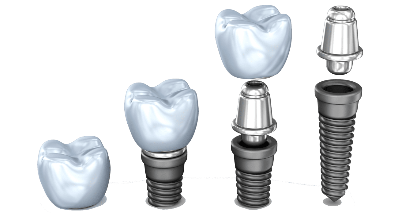 implant pieces plantation fl
